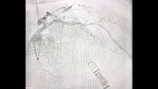 Complex ostial LAD stenosis How to tackle [upl. by Lebazi]