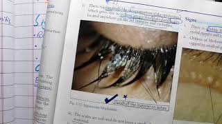 Eyelid  Blepharitis Part 4 [upl. by Auston]