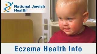 What is Eczema and How Is it Treated [upl. by Maddox852]