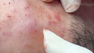 Relaxing Acne Treatment Everyday With Vu Quynh Mi SpaBlackheads Removal Cystic Removal 2023 030 [upl. by Eseenaj]