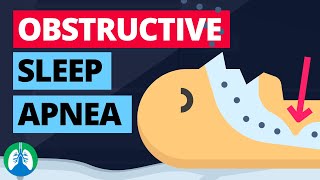 Obstructive Sleep Apnea Medical Definition  Quick Explainer Video [upl. by Akiehsat365]