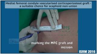 Medial femoral condyle vascularised corticoperiosteal graft [upl. by Teteak]