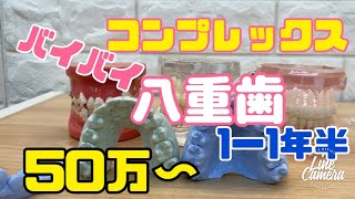 332八重歯を1年で白いワイヤー矯正 後戻りに注意 50万税抜〜大宮 鈴木歯科医院 矯正歯科 [upl. by Roane656]