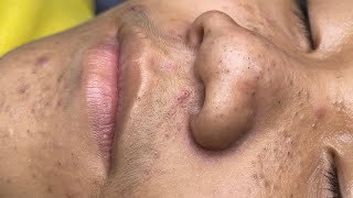 ACNE TREATMENT VU QUYNH MI  Blackheads Chin amp Nose Of Tweens 2024 EX [upl. by Kentigerma]