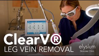 ClearV® Laser for Leg Vein Removal [upl. by Ahtekahs460]