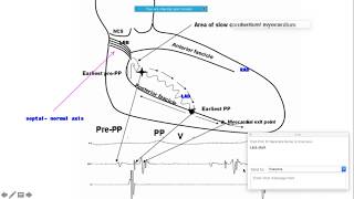 FascicularVT  Approach to ablation with basics ecgbasics bellhassenvt CardiacElectrophysiology [upl. by Tehc]