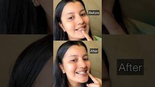 I Tried This Teeth Whitening Solution Under ₹500 [upl. by Ateloiv152]