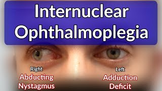 Internuclear Ophthalmoplegia  Left INO Case example explained [upl. by Gilroy225]