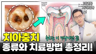 이 증상 무시하면 큰 돈 나갑니다 충치의 종류와 치료법 총정리 [upl. by Weston]