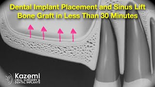 Dental Implant Placement and Sinus Lift Bone Graft in Less Than 30 Minutes [upl. by Sydelle]