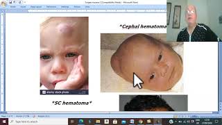 Trauma in Arabic 7 Scalp Haematoma  by Dr Wahdan [upl. by Isabel]