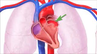 Semiologia Ausculta Cardíaca  Insuficiência mitral [upl. by Lynnelle971]