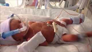 28 Week Preemie Sophias One Year Journey [upl. by Neened717]