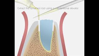 DIT Fractured tooth extraction [upl. by Uri]