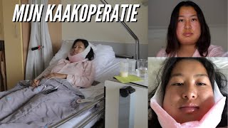 Mijn Kaakoperatie  1 Week Herstel Erna 🏥 Deel 12 [upl. by Naibaf]