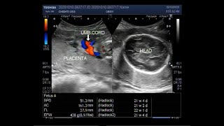 Ultrasound Video showing extreme of Oligohydromnios is Anhydramnios [upl. by Wistrup895]