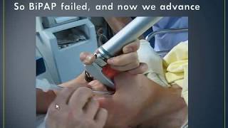 Mechanical Ventilation – Invasive and Noninvasive [upl. by Dnomso551]