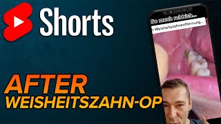 Speisereste nach Zahnextraktion shorts [upl. by Rhee49]