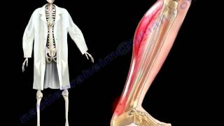 Achilles Tendon Stress amp Strain  Everything You Need To Know  Dr Nabil Ebraheim [upl. by Calv]