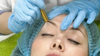 Microdermabrasion amp Acne Scars  Acne Treatment [upl. by Maddie431]