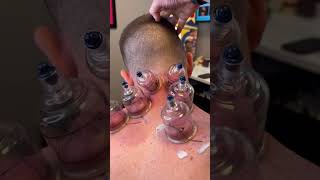 Cupping therapy procedure and why it is important for athlete see video description cupping short [upl. by Alimat]