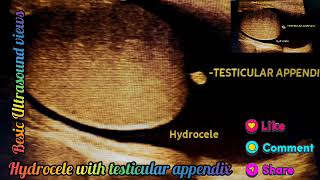 Hydrocele with testicular appendix in ultrasound usg views [upl. by Otter]