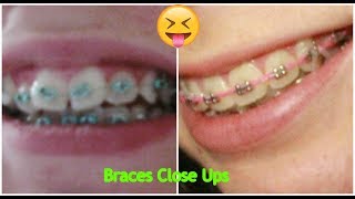 Braces Close Ups [upl. by Zizaludba]