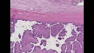 Histopathology OvaryBorderline ovarian tumor [upl. by Kathleen]