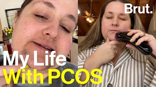 This is PCOS [upl. by Kinsley]