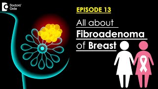 What Are Fibroadenomas Are They Precancerous Treatment OptionsDrSreekanth Reddy Doctors Circle [upl. by Hawkie]