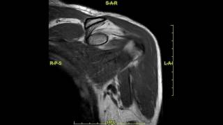 Bankart lesion of the shoulder  complete MRI examination [upl. by Moreno]