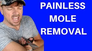 BEST WAY TO REMOVE MOLES  SKIN TAGS TOO  Chris Gibson [upl. by Corsetti629]