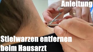 Fibrome Stielwarze schnell und schmerzfrei entfernen mit Schere beim Hausarzt [upl. by Airdnaxela]