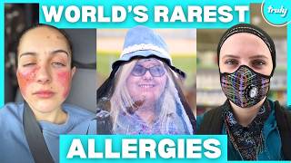 The Worlds Rarest Allergies  BORN DIFFERENT [upl. by Jenei]