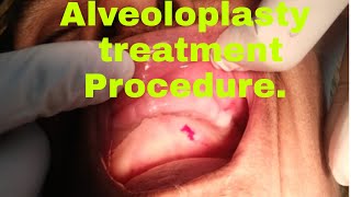 Alveoloplasty  local anaesthesia  suture  bone cutting  injections  bone spicule  denture [upl. by Sivle755]