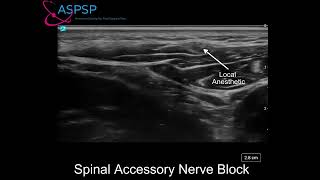 Ultrasound Guided Spinal Accessory Nerve Block [upl. by Nulubez939]