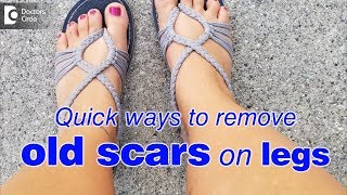 How to remove old scars on legs fast  Dr Rasya Dixit [upl. by Limaj676]