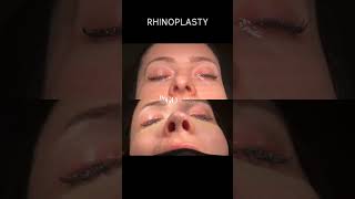 Patient Journey Rhinoplasty Transformation 🌟 [upl. by Wilie]