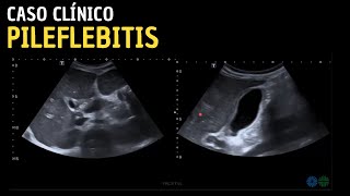 Caso clínico 109 Pileflebitis  Tromboflebitis venosa portal supurativa [upl. by Nuhsal91]