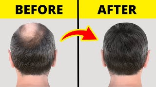 10 Guaranteed Ways to Regrow Hair Fast  🚫 No Surgery [upl. by Adnavoj]