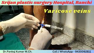 varicose veins  treatment by foam Sclerotherapy Varicose veins treatment in Ranchi varicoseveins [upl. by Head]