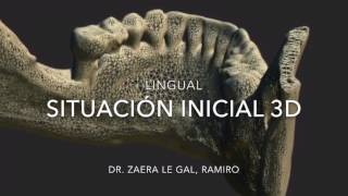 Regeneración ósea del propio paciente sin injertos  Implantes dentales [upl. by Cob]