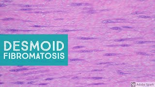 Desmoid Fibromatosis Desmoid Tumor  Explained by a Soft Tissue Pathologist [upl. by Gromme]