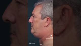 Watch the Incredible Results Neck Lift amp Liposuction Transformation [upl. by Tav]