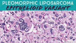 Pleomorphic Liposarcoma Epithelioid Variant [upl. by Eardnoed]