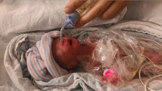 25 Week Micro Preemie 35 months premature Born at 1 lb  Happy 1st Birthday Emma [upl. by Akkin]