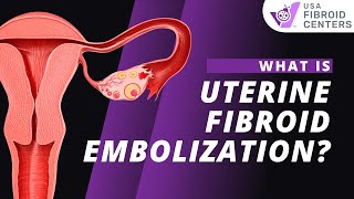 Watch How UFE Uterine Fibroid Embolization Works [upl. by Atiuqrehs373]