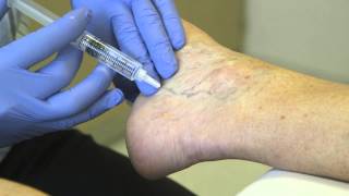 Spider Vein Treatment  Sclero Therapy [upl. by Cir644]