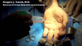 Hand Foreign Body Removal  Ultrasound Guided [upl. by Yovonnda921]