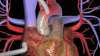 Coronaire bypass CABG [upl. by Azarria]